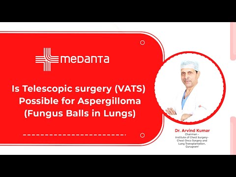  Is Telescopic surgery (VATS) Possible for Aspergilloma (Fungus Balls in Lungs)? 